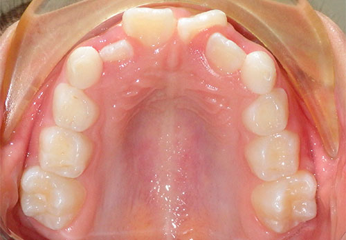 Tratamiento Temprano D-Gainer