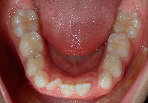 Tratamiento Temprano D-Gainer