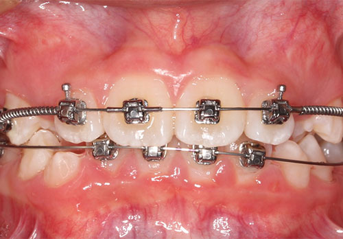 Tratamiento Temprano D-Gainer