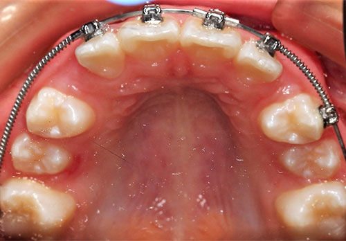 Tratamiento Temprano D-Gainer