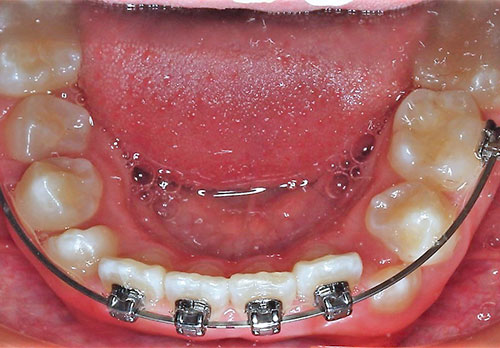 Tratamiento Temprano D-Gainer