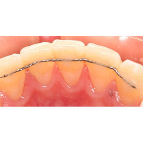 Retenedores fijos Cali