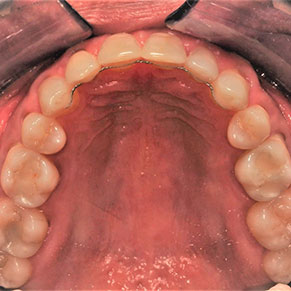 Retenedores fijos Cali